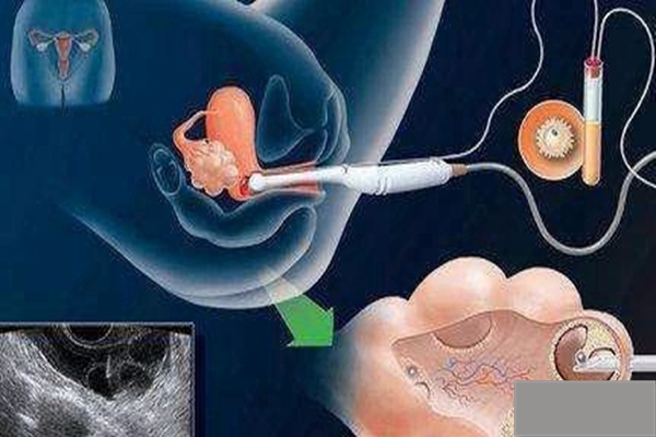 太原龙凤胎助孕产子
:试管婴儿胚胎移植后有哪些症状是正常的移植后有哪些症状是正常的？(图4)