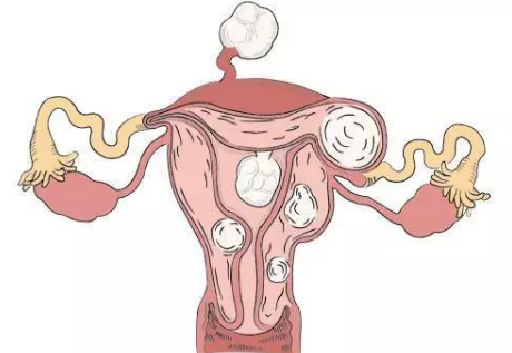 济宁助孕生子中介：子宫肌瘤对妇女的健康和安全有危害，本文介绍了预防和检测子宫肌瘤的方法。(图1)